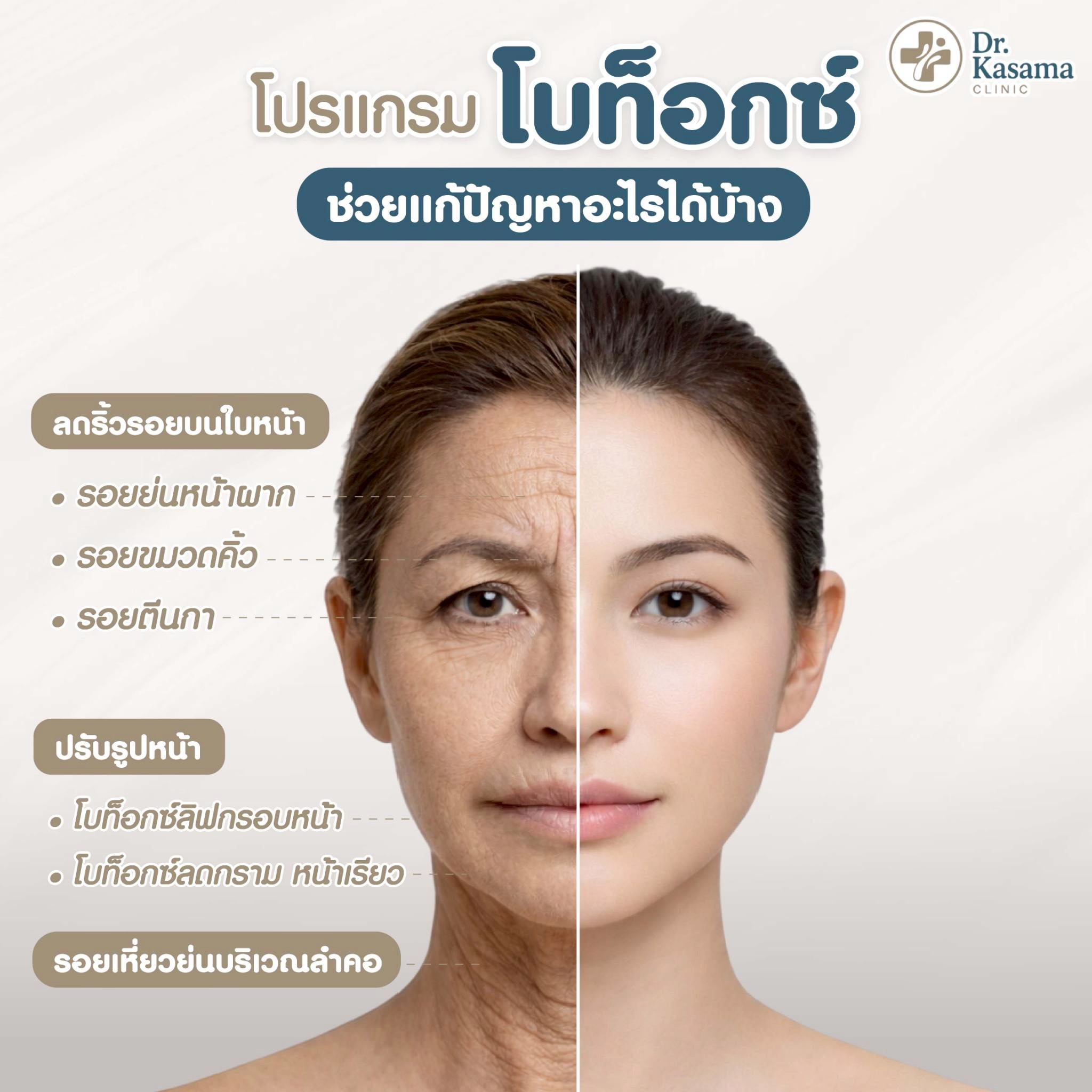โบท็อกซ์